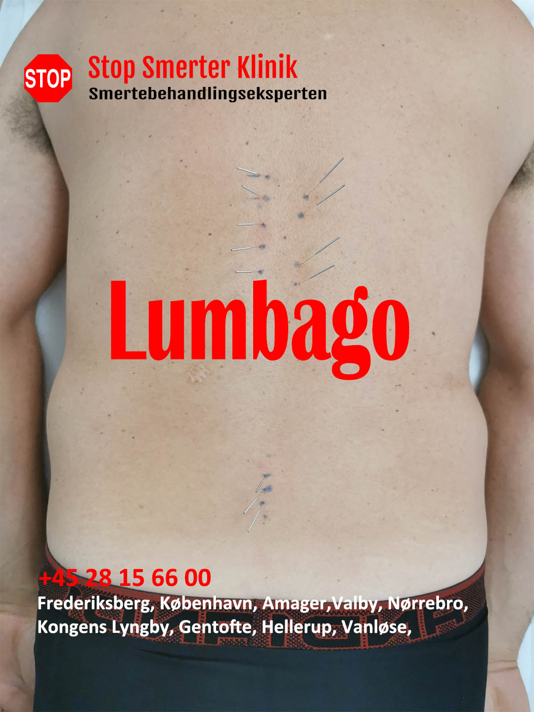 Lumbago – En 42-årige mand, ca. 8 måneder – Smerter Akupunktur