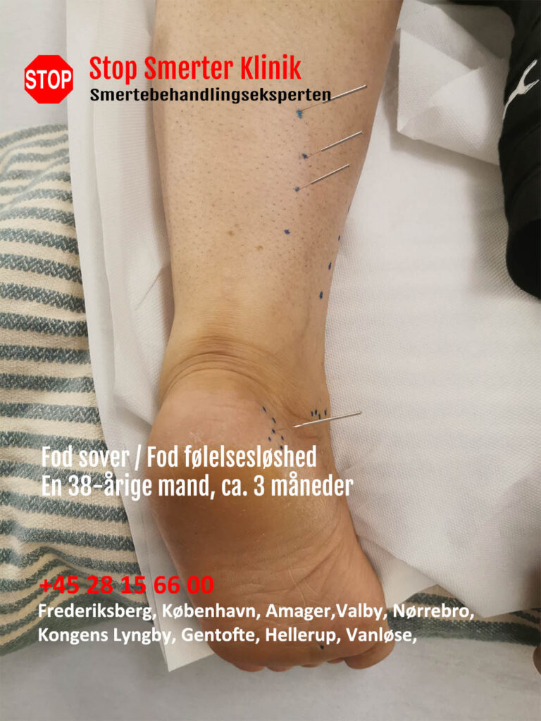 Fod sover og Fod følelsesløshed i Frederiksberg