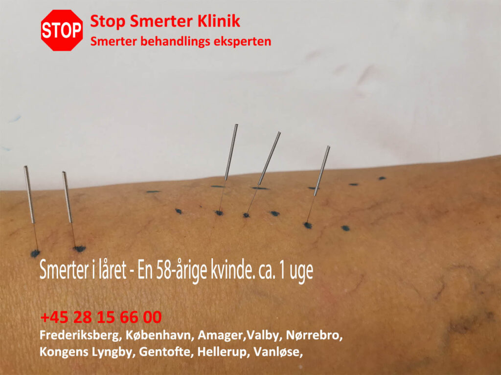Smerter i låret i Frederiksberg