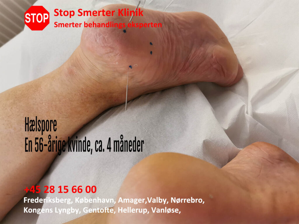 Hælspore i Frederiksberg