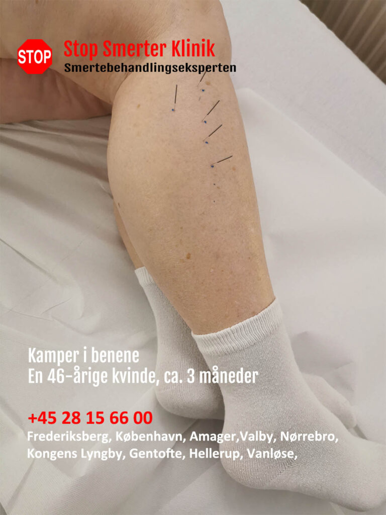 Kamper i benene i Frederiksberg